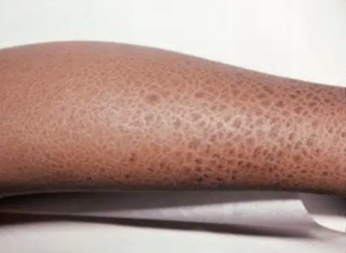 Urelia - Scaly Skin & Hyperkeratosis